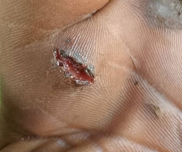 Domestic Cat Rabies Open wound on palm