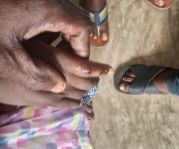 Five Victims One Rabid Dog 1 Wound on finger