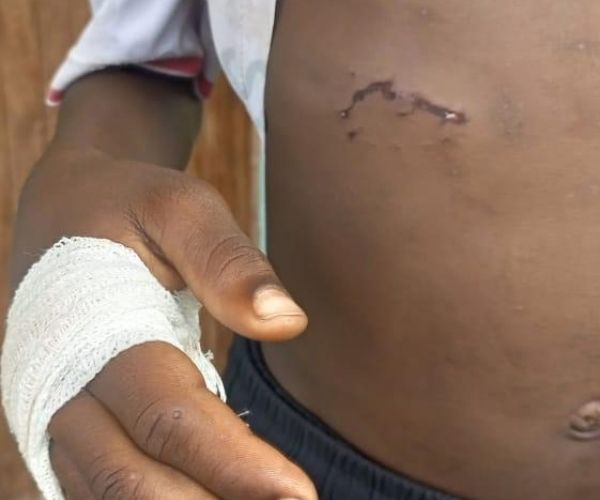 Five Victims One Rabid Dog 2 Wounded abdomen and hand with bandage