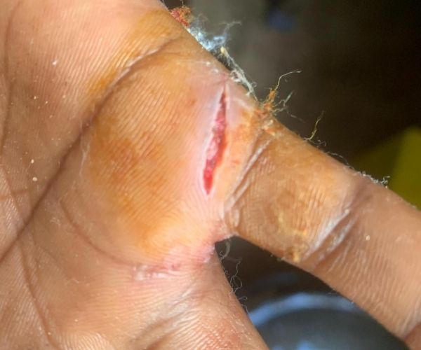 Five Victims One Rabid Dog 4 Cut on hand